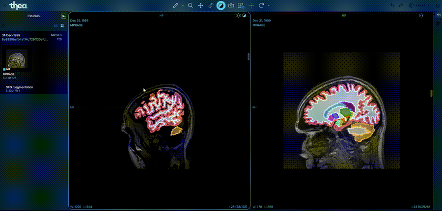 Segmentación médica