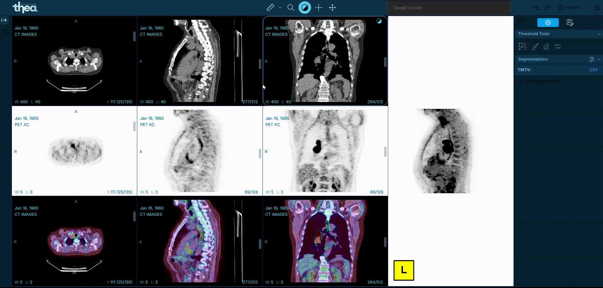 Fisioterapia y Tomografía Computarizada