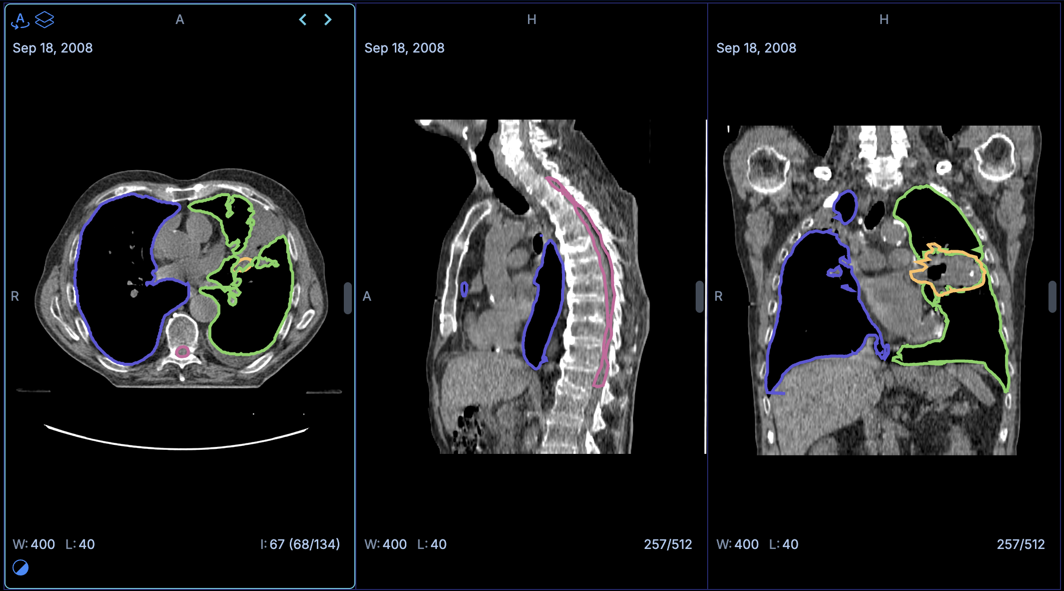 Visualización multiplanar avanzada para conjuntos de estructuras RT